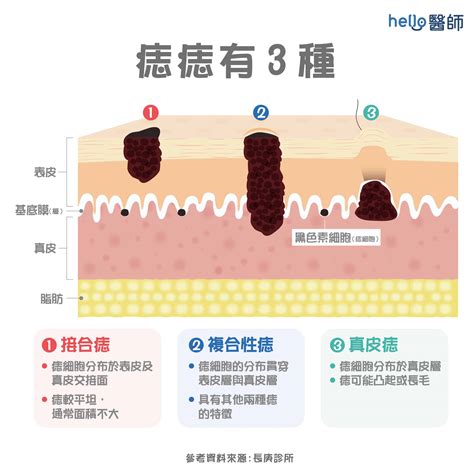 痣長白毛|痣形成的原因？痣長毛、痣變多變大是痣病變？5招判。